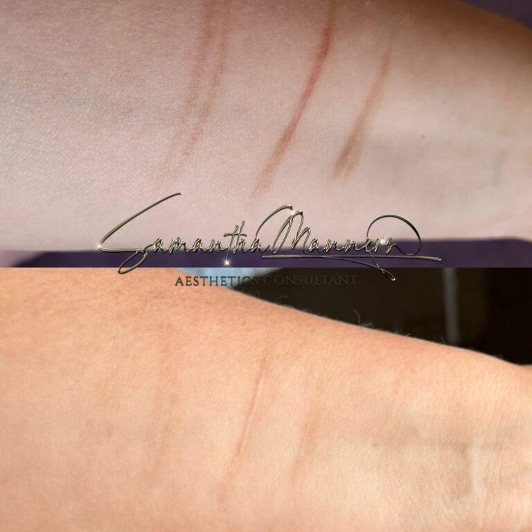 Medical 7 Scar camouflage tattooing before after Warwickshire