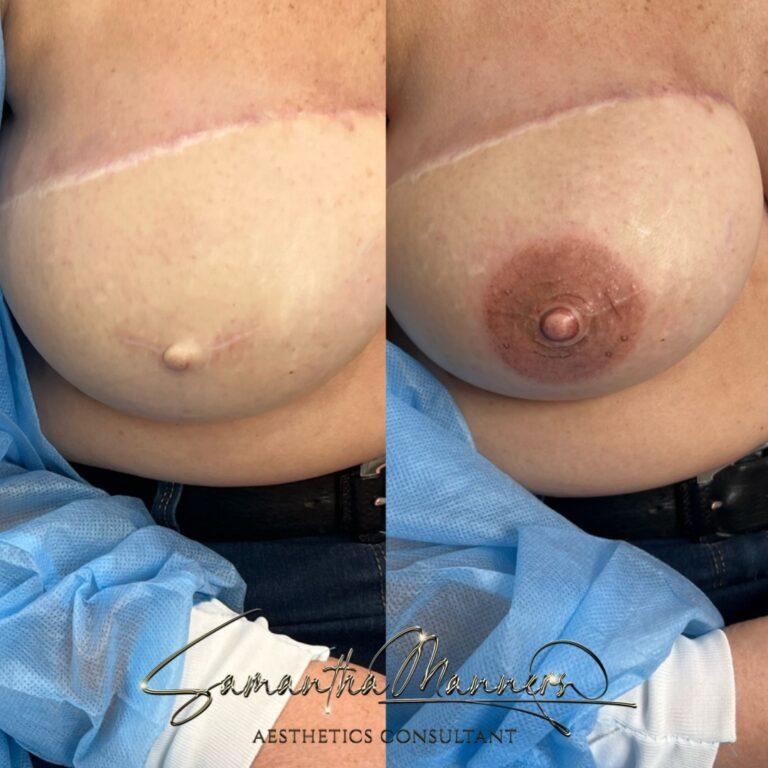 Medical 4 3D areola reconstruction Atherstone breast cancer survivor